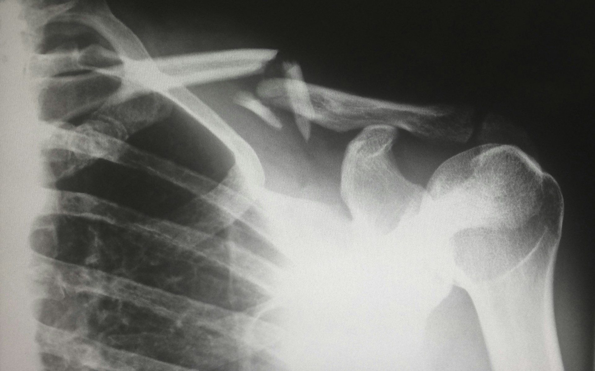 An X-ray used in an Aiken workers’ comp case that details a damaged shoulder