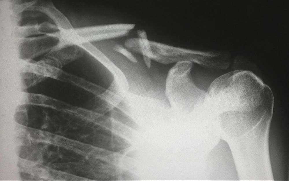 An X-ray of a broken shoulder used in a Saluda, SC, workers’ comp case