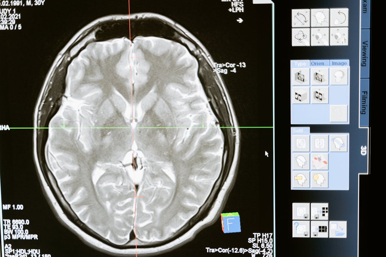 An x-ray of a brain used as evidence in a TBI case