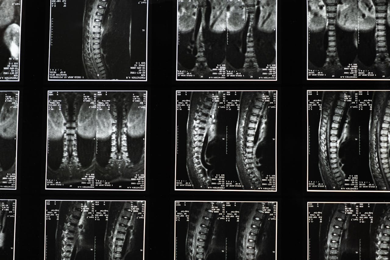 X-rays used in a spinal cord injury case